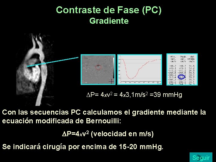 Contraste de Fase (PC) Gradiente DP= 4 xv 2 = 4 x 3, 1 Contraste de Fase (PC) Gradiente DP= 4 xv 2 = 4 x 3, 1