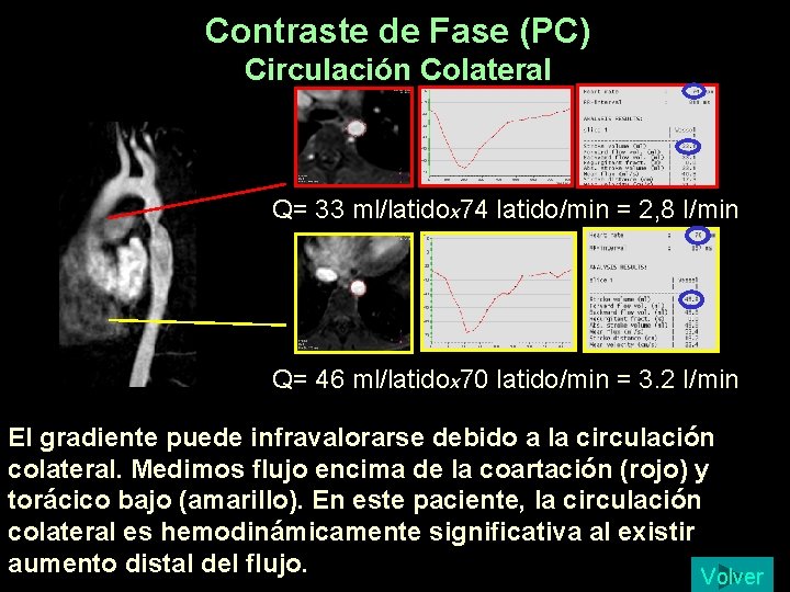 Contraste de Fase (PC) Circulación Colateral Q= 33 ml/latidox 74 latido/min = 2, 8 Contraste de Fase (PC) Circulación Colateral Q= 33 ml/latidox 74 latido/min = 2, 8