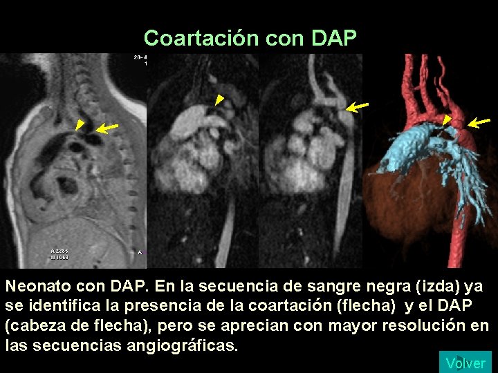 Coartación con DAP Neonato con DAP. En la secuencia de sangre negra (izda) ya Coartación con DAP Neonato con DAP. En la secuencia de sangre negra (izda) ya