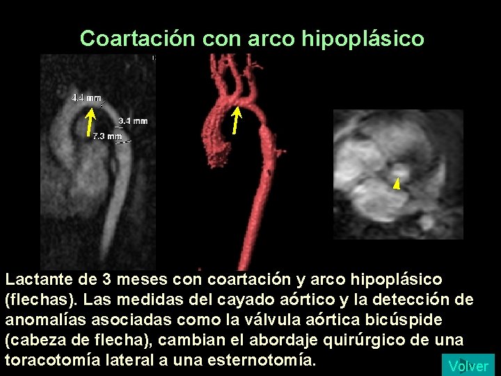 Coartación con arco hipoplásico Lactante de 3 meses con coartación y arco hipoplásico (flechas). Coartación con arco hipoplásico Lactante de 3 meses con coartación y arco hipoplásico (flechas).