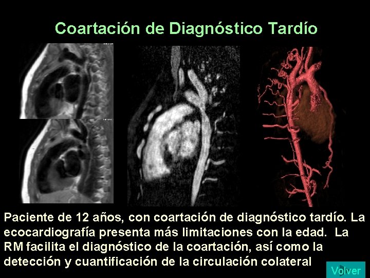 Coartación de Diagnóstico Tardío Paciente de 12 años, con coartación de diagnóstico tardío. La Coartación de Diagnóstico Tardío Paciente de 12 años, con coartación de diagnóstico tardío. La