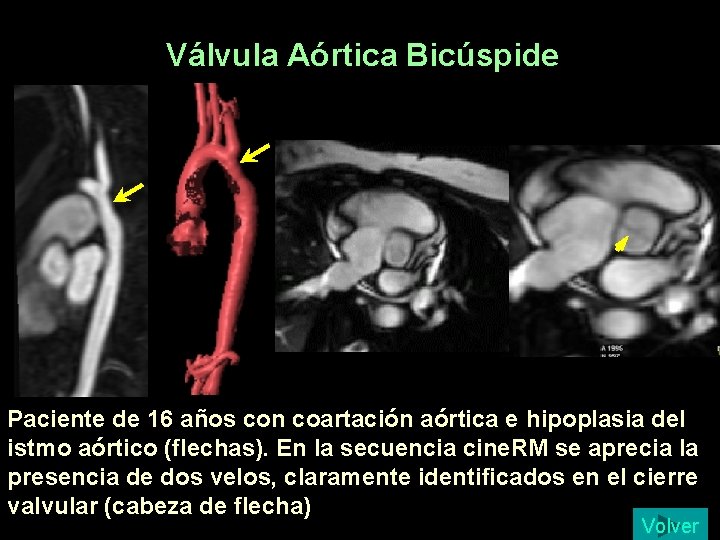 Válvula Aórtica Bicúspide Paciente de 16 años con coartación aórtica e hipoplasia del istmo Válvula Aórtica Bicúspide Paciente de 16 años con coartación aórtica e hipoplasia del istmo