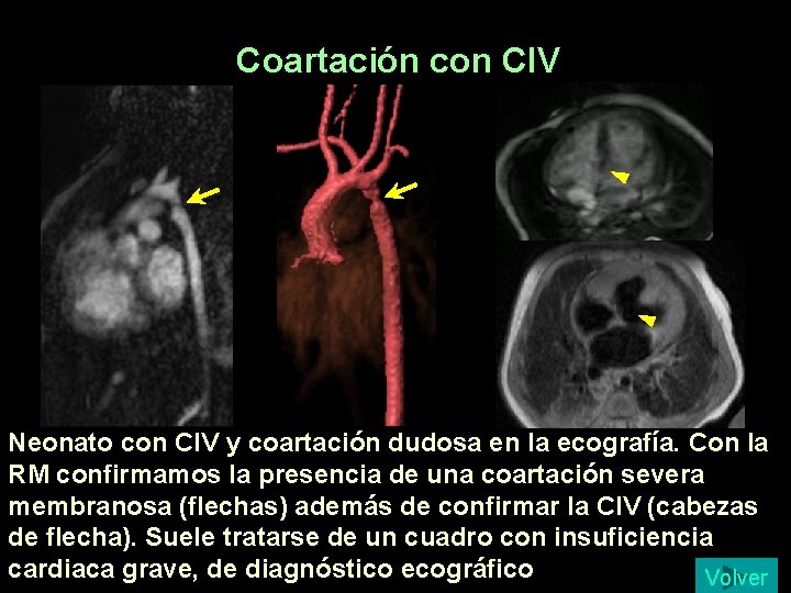 Coartación con CIV Neonato con CIV y coartación dudosa en la ecografía. Con la Coartación con CIV Neonato con CIV y coartación dudosa en la ecografía. Con la