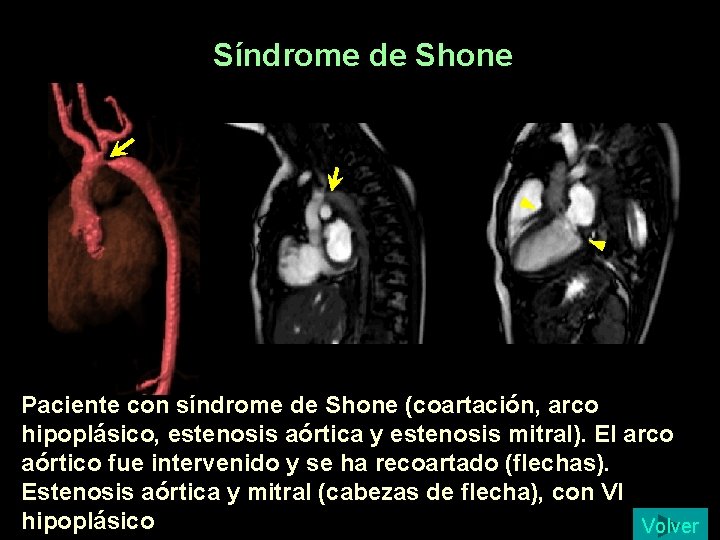 Síndrome de Shone Paciente con síndrome de Shone (coartación, arco hipoplásico, estenosis aórtica y Síndrome de Shone Paciente con síndrome de Shone (coartación, arco hipoplásico, estenosis aórtica y