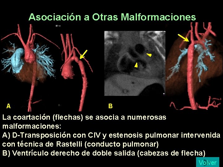 Asociación a Otras Malformaciones A B La coartación (flechas) se asocia a numerosas malformaciones: Asociación a Otras Malformaciones A B La coartación (flechas) se asocia a numerosas malformaciones: