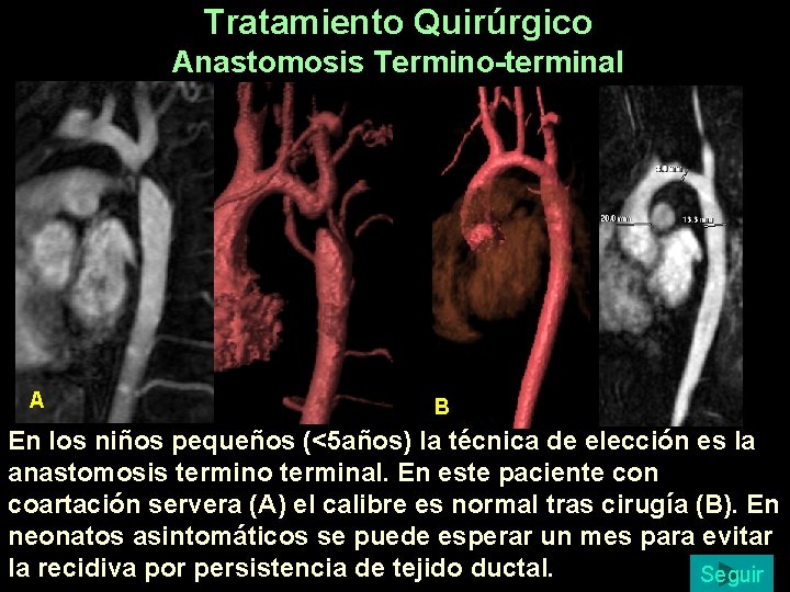 Tratamiento Quirúrgico Anastomosis Termino-terminal A B En los niños pequeños (<5 años) la técnica Tratamiento Quirúrgico Anastomosis Termino-terminal A B En los niños pequeños (<5 años) la técnica