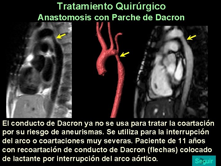 Tratamiento Quirúrgico Anastomosis con Parche de Dacron El conducto de Dacron ya no se Tratamiento Quirúrgico Anastomosis con Parche de Dacron El conducto de Dacron ya no se