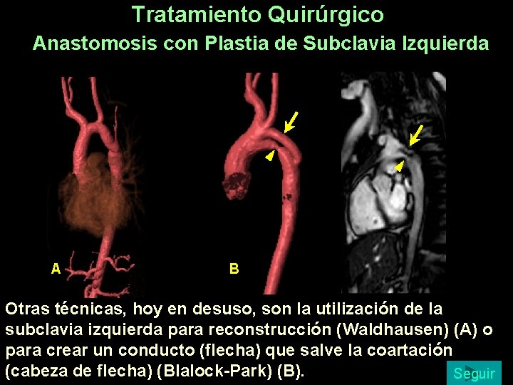 Tratamiento Quirúrgico Anastomosis con Plastia de Subclavia Izquierda A B Otras técnicas, hoy en Tratamiento Quirúrgico Anastomosis con Plastia de Subclavia Izquierda A B Otras técnicas, hoy en
