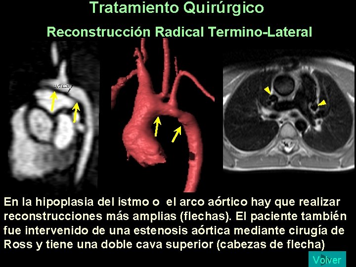 Tratamiento Quirúrgico Reconstrucción Radical Termino-Lateral En la hipoplasia del istmo o el arco aórtico Tratamiento Quirúrgico Reconstrucción Radical Termino-Lateral En la hipoplasia del istmo o el arco aórtico
