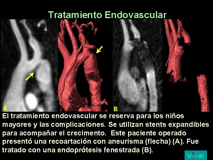 Tratamiento Endovascular A B El tratamiento endovascular se reserva para los niños mayores y Tratamiento Endovascular A B El tratamiento endovascular se reserva para los niños mayores y