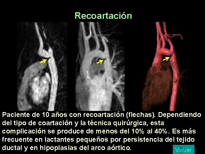 Recoartación Paciente de 10 años con recoartación (flechas). Dependiendo del tipo de coartación y Recoartación Paciente de 10 años con recoartación (flechas). Dependiendo del tipo de coartación y