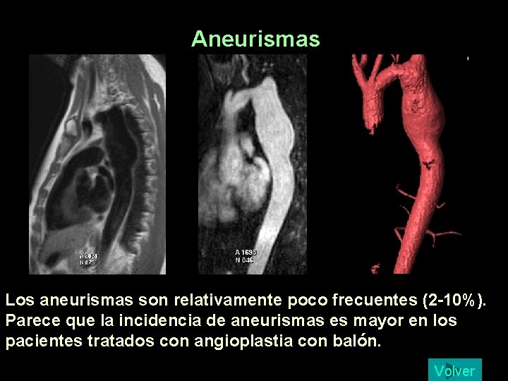 Aneurismas Los aneurismas son relativamente poco frecuentes (2 -10%). Parece que la incidencia de Aneurismas Los aneurismas son relativamente poco frecuentes (2 -10%). Parece que la incidencia de