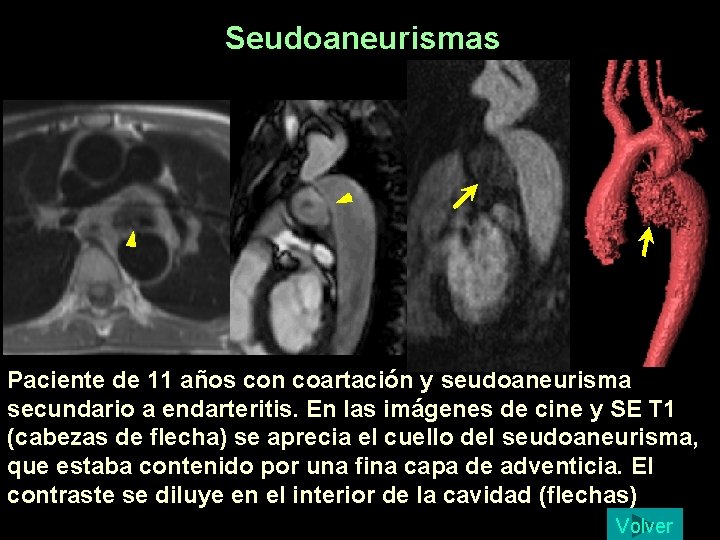 Seudoaneurismas Paciente de 11 años con coartación y seudoaneurisma secundario a endarteritis. En las Seudoaneurismas Paciente de 11 años con coartación y seudoaneurisma secundario a endarteritis. En las