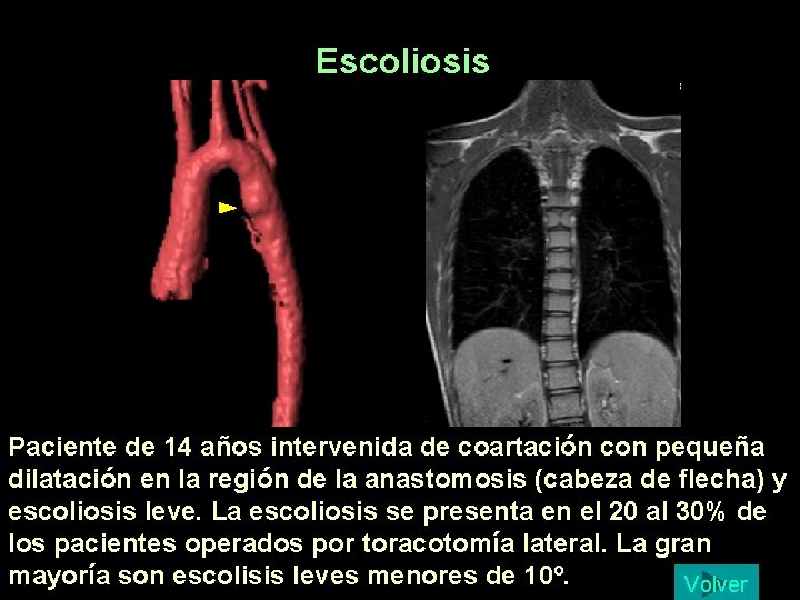 Escoliosis Paciente de 14 años intervenida de coartación con pequeña dilatación en la región Escoliosis Paciente de 14 años intervenida de coartación con pequeña dilatación en la región