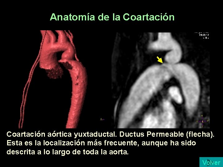 Anatomía de la Coartación aórtica yuxtaductal. Ductus Permeable (flecha). Esta es la localización más Anatomía de la Coartación aórtica yuxtaductal. Ductus Permeable (flecha). Esta es la localización más