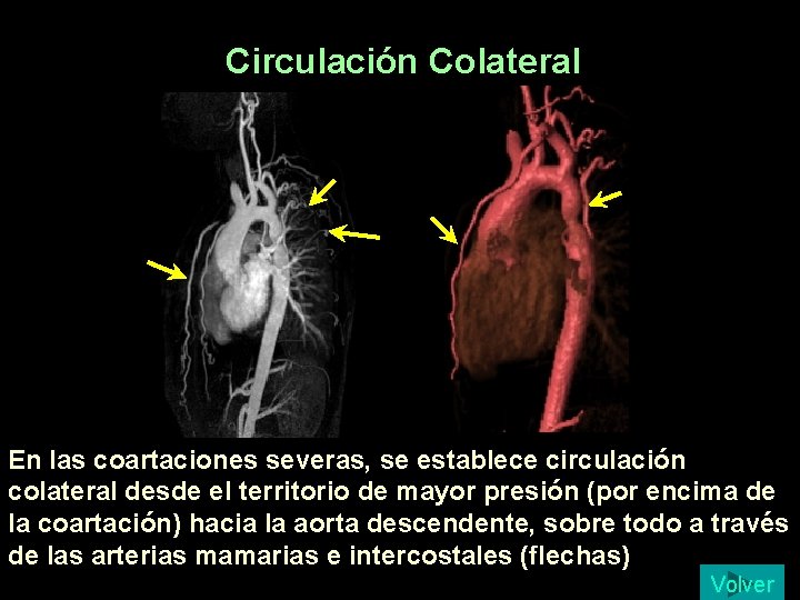 Circulación Colateral En las coartaciones severas, se establece circulación colateral desde el territorio de Circulación Colateral En las coartaciones severas, se establece circulación colateral desde el territorio de