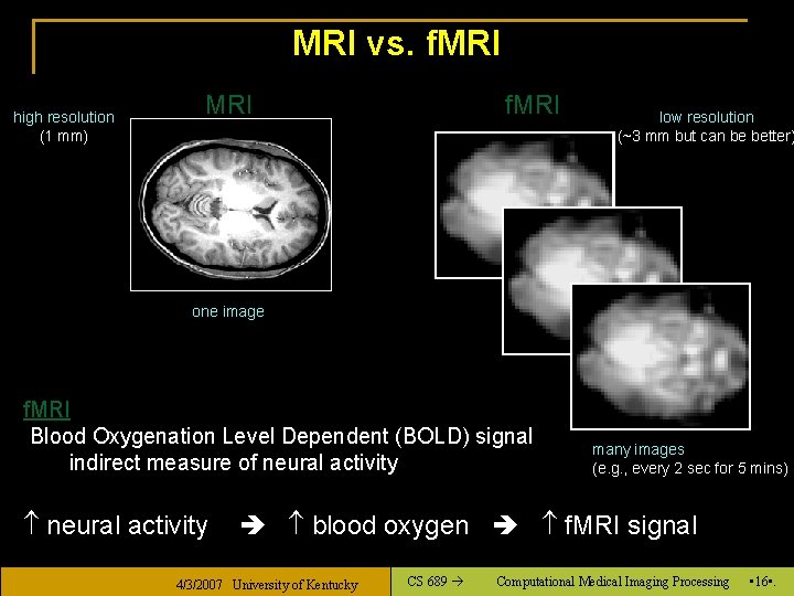 MRI vs. f. MRI high resolution (1 mm) MRI f. MRI low resolution (~3