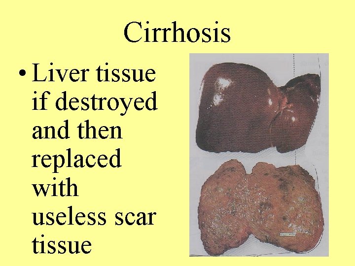 Cirrhosis • Liver tissue if destroyed and then replaced with useless scar tissue 