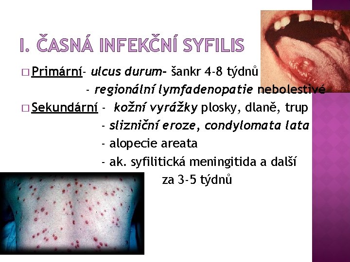 I. ČASNÁ INFEKČNÍ SYFILIS � Primární- ulcus durum- šankr 4 -8 týdnů - regionální