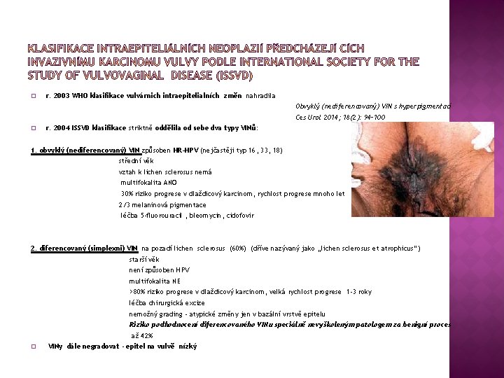 � r. 2003 WHO klasifikace vulvárnich intraepitelialních změn nahradila Obvyklý (nediferencovaný) VIN s hyperpigmentací