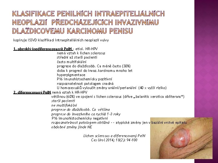 kopíruje ISSVD klasifikaci intraepiteliálních neoplazií vulvy 1. obvyklý (nediferencovaný) Pe. IN – etiol. HR-HPV