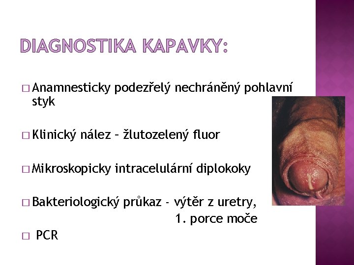 DIAGNOSTIKA KAPAVKY: � Anamnesticky styk � Klinický podezřelý nechráněný pohlavní nález – žlutozelený fluor