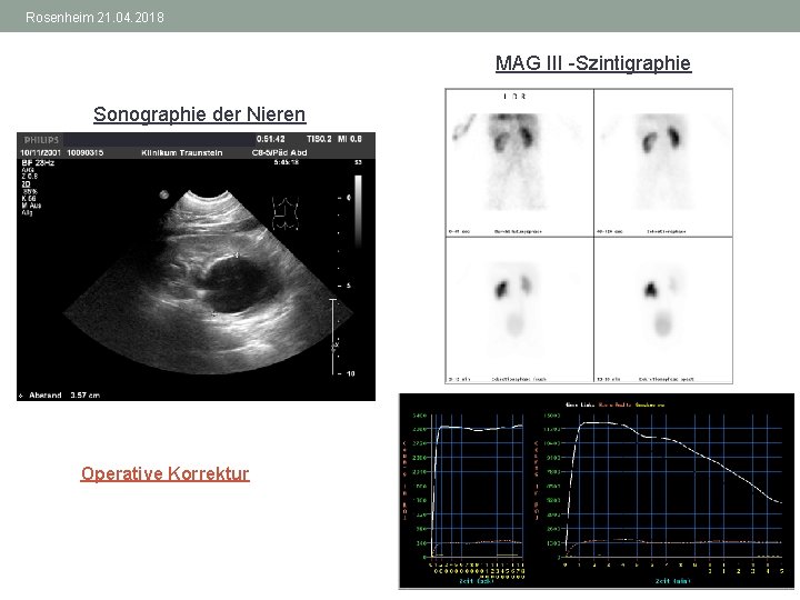 Rosenheim 21. 04. 2018 MAG III -Szintigraphie Sonographie der Nieren Operative Korrektur 