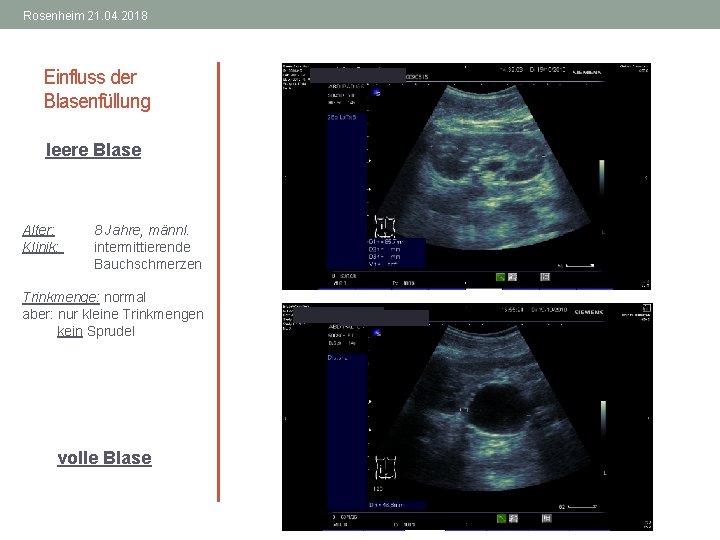 Rosenheim 21. 04. 2018 Einfluss der Blasenfüllung leere Blase Alter: Klinik: 8 Jahre, männl.