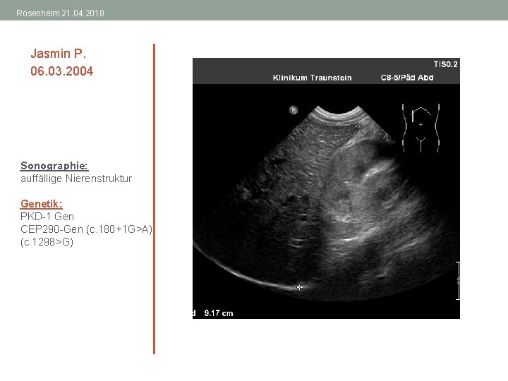 Rosenheim 21. 04. 2018 Jasmin P. 06. 03. 2004 Sonographie: auffällige Nierenstruktur Genetik: PKD-1