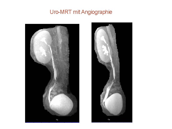 Uro-MRT mit Angiographie 