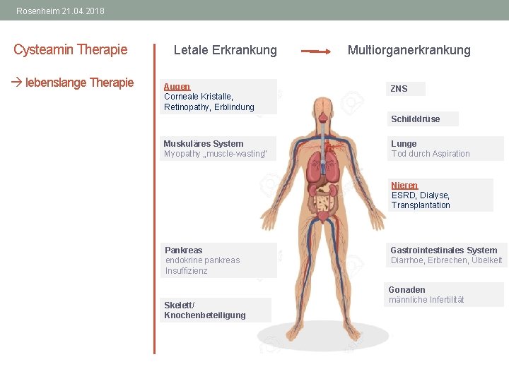 Rosenheim 21. 04. 2018 Cysteamin Therapie lebenslange Therapie Letale Erkrankung Multiorganerkrankung Augen Corneale Kristalle,
