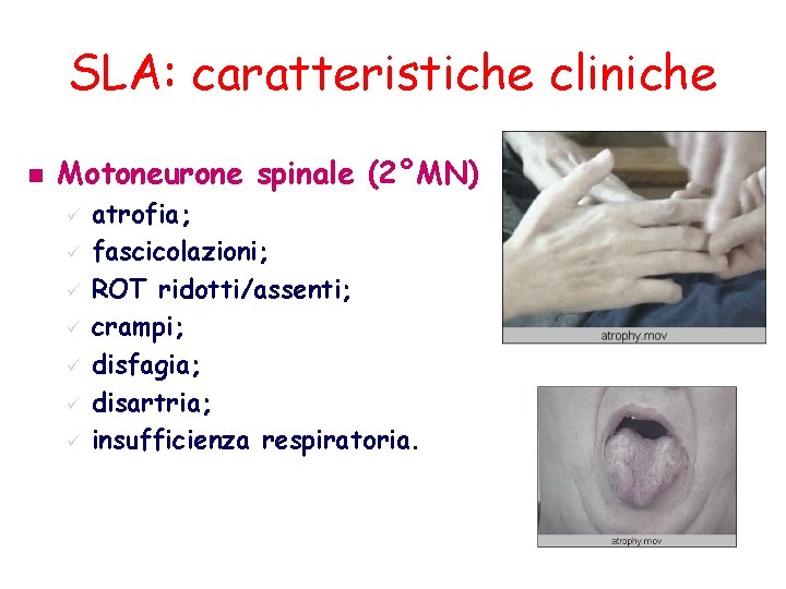 SLA: caratteristiche cliniche n Motoneurone spinale (2°MN) ü ü ü ü atrofia; fascicolazioni; ROT