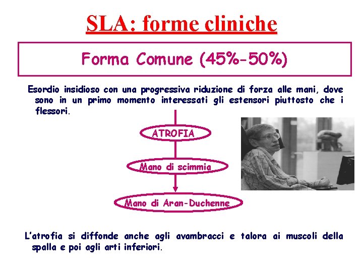 SLA: forme cliniche Forma Comune (45%-50%) Esordio insidioso con una progressiva riduzione di forza