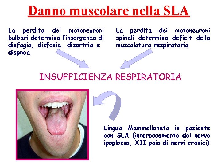 Danno muscolare nella SLA La perdita dei motoneuroni bulbari determina l’insorgenza di disfagia, disfonia,