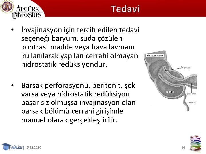 Tedavi • İnvajinasyon için tercih edilen tedavi seçeneği baryum, suda çözülen kontrast madde veya