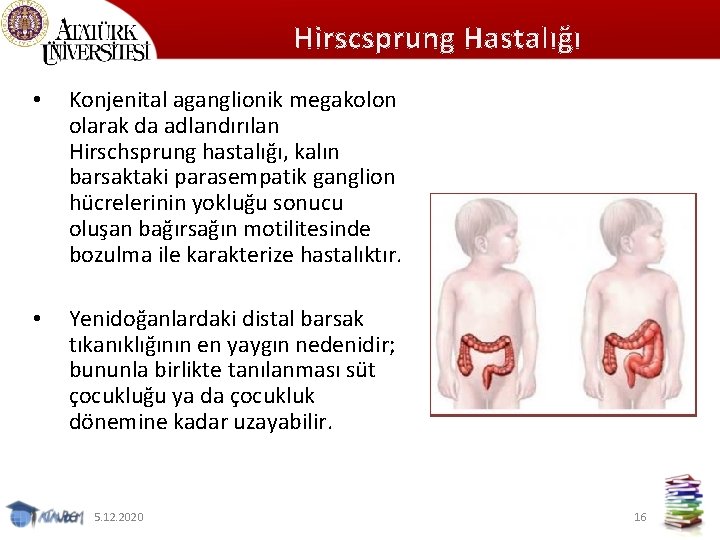 Hirscsprung Hastalığı • Konjenital aganglionik megakolon olarak da adlandırılan Hirschsprung hastalığı, kalın barsaktaki parasempatik