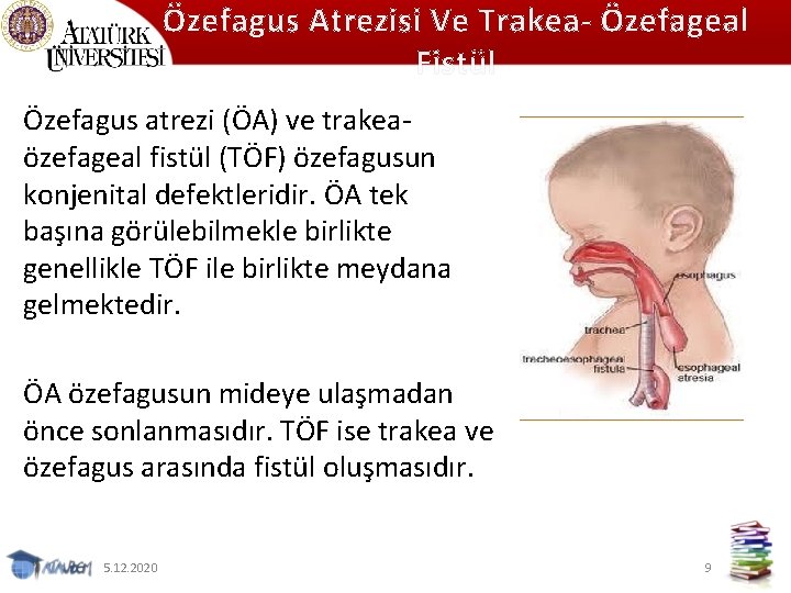 Özefagus Atrezisi Ve Trakea- Özefageal Fistül Özefagus atrezi (ÖA) ve trakea özefageal fistül (TÖF)