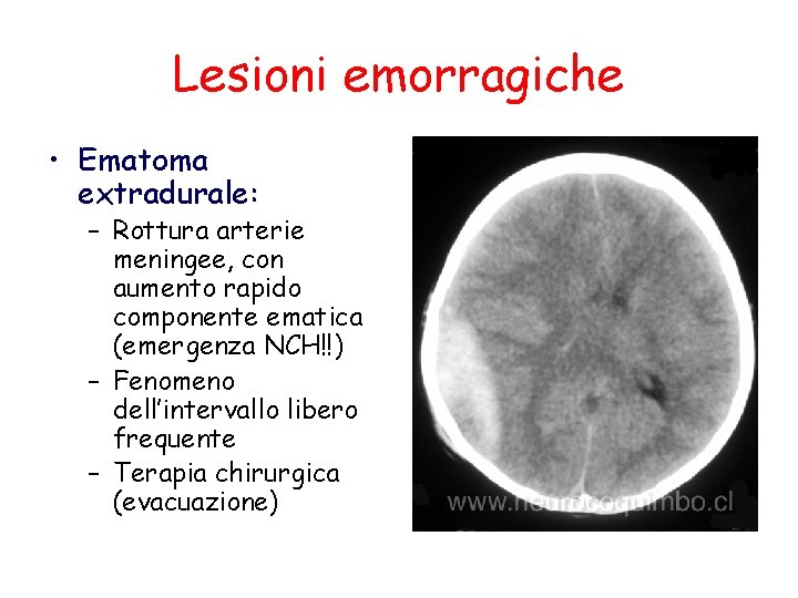 Lesioni emorragiche • Ematoma extradurale: – Rottura arterie meningee, con aumento rapido componente ematica