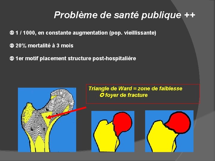 Problème de santé publique ++ 1 / 1000, en constante augmentation (pop. vieillissante) 20%