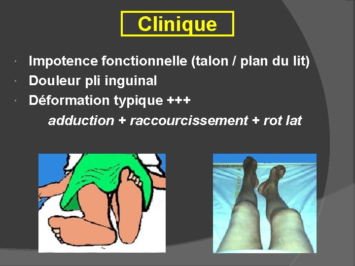 Clinique Impotence fonctionnelle (talon / plan du lit) Douleur pli inguinal Déformation typique +++