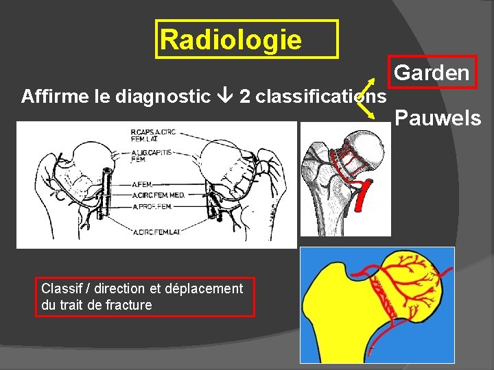 Radiologie Garden Affirme le diagnostic 2 classifications Classif / direction et déplacement du trait