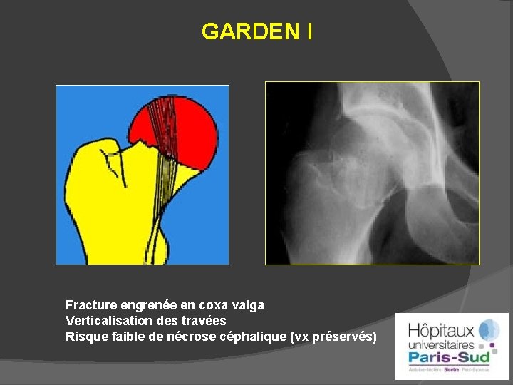 GARDEN I Fracture engrenée en coxa valga Verticalisation des travées Risque faible de nécrose