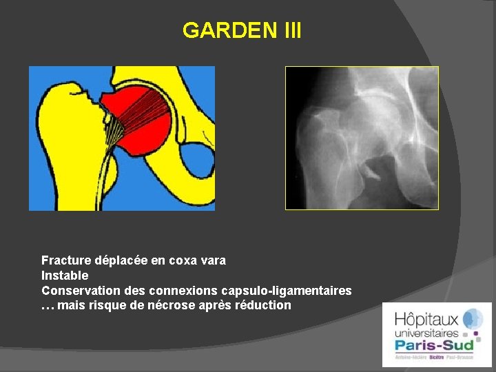 GARDEN III Fracture déplacée en coxa vara Instable Conservation des connexions capsulo-ligamentaires … mais