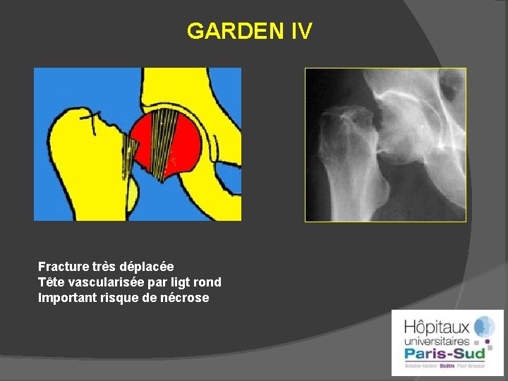 GARDEN IV Fracture très déplacée Tête vascularisée par ligt rond Important risque de nécrose