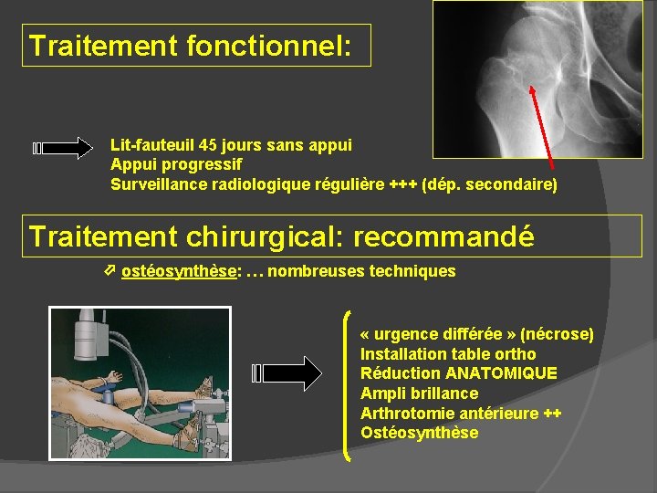 Traitement fonctionnel: Lit-fauteuil 45 jours sans appui Appui progressif Surveillance radiologique régulière +++ (dép.
