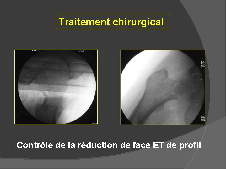 Traitement chirurgical Contrôle de la réduction de face ET de profil 