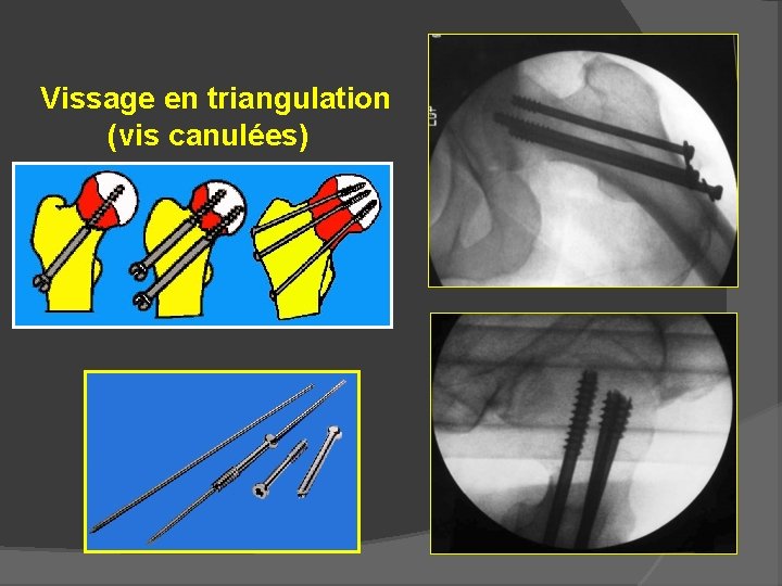 Vissage en triangulation (vis canulées) 
