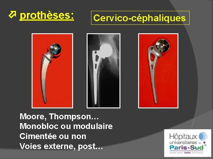  prothèses: Cervico-céphaliques Moore, Thompson… Monobloc ou modulaire Cimentée ou non Voies externe, post…