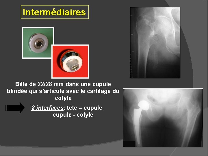 Intermédiaires Bille de 22/28 mm dans une cupule blindée qui s’articule avec le cartilage