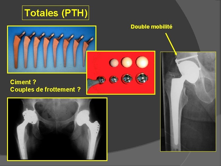 Totales (PTH) Double mobilité Ciment ? Couples de frottement ? 